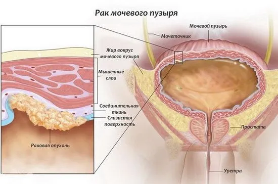 Защо боли пикочния мехур Какво да правя