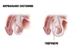 тестисите