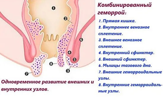 Какво представляват комбинираните хемороиди?