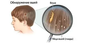 Въшки при дете. Причини за появата и методи на борба