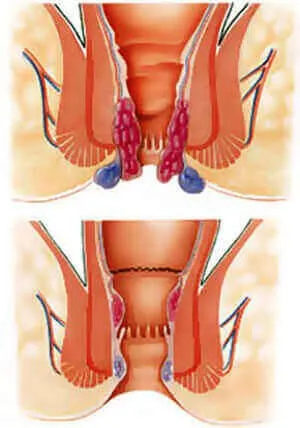 Хемороидите се лекуват на различни етапи на развитие