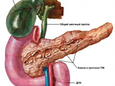 Причини, диагноза, симптоми и лечение на билиарен панкреатит