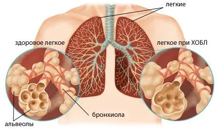 Лечение на хронична обструктивна белодробна болест