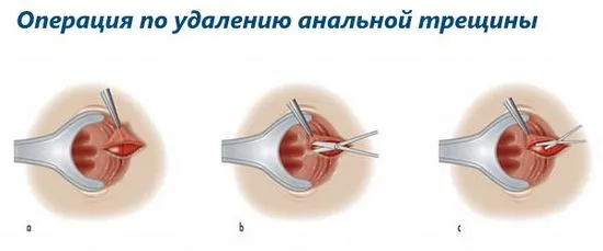 изрязване на аналната фисура