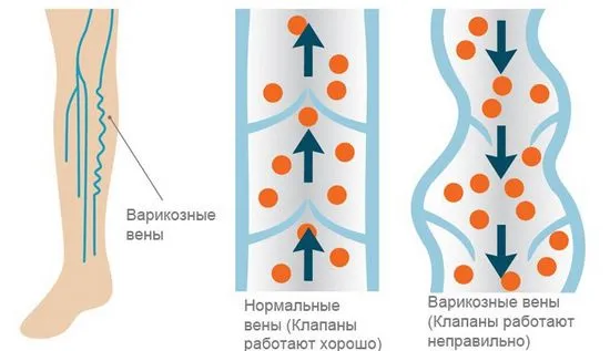 Симптоми на разширени вени