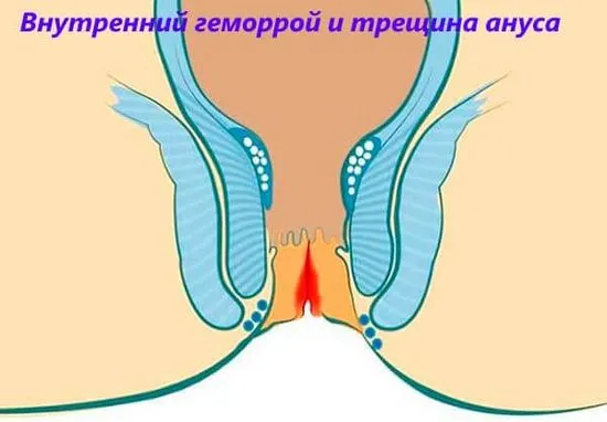 Лечение на хемороиди и ректални фисури, характеристики на общото заболяване