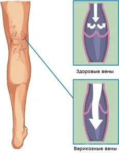 Има вени по краката какво да правите за лечение