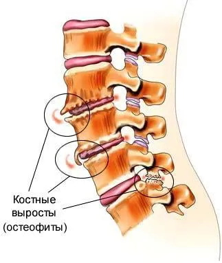 Причини, видове и лечение на остеофити