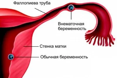 Дърпащи болки в долната част на корема (вляво, вдясно) по време на бременност