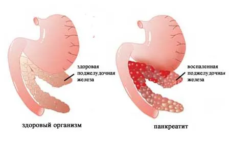 Прополис за лечение на панкреатит и рецепти с мляко