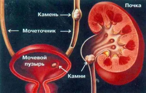 Причини за бъбречна колика