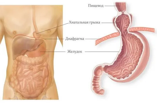 Херния на отвора на хранопровода на диафрагмата симптоми, причини, лечение