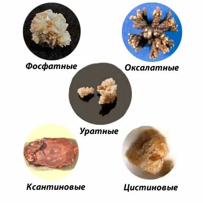 Видове камъни в бъбреците, причини, симптоми, лечение