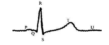 Jellemzői normális EKG 1