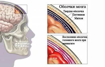 Mindent a meningitis kezelésére, a tünetek a meningitis