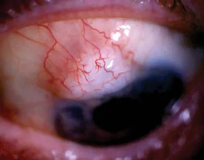 Tratamentul chirurgical al glaucomului primar