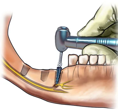 sebészeti implantátumok