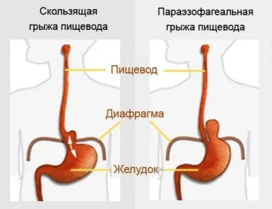 Херния на отвора на хранопровода на диафрагмата, симптоми, лечение