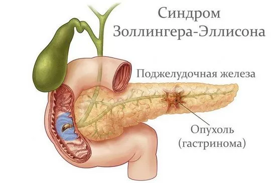 Синдром на Zollinger-Ellison, симптоми, причини,лечение