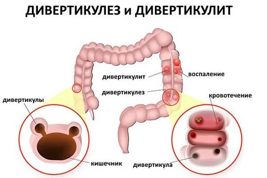 Симптоми и лечение на дивертикулоза