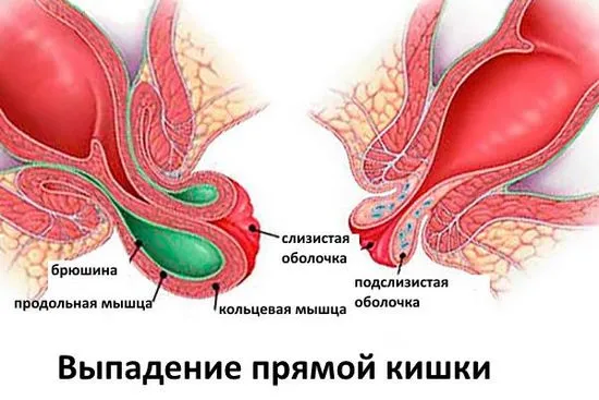 Какви са симптомите на ректален пролапс