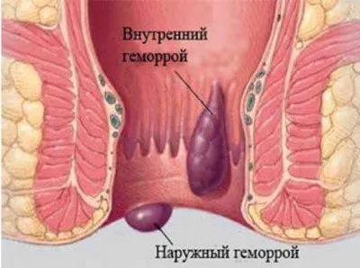 Най-ефективните супозитории за хемороиди са болкоуспокояващи, хемостатични