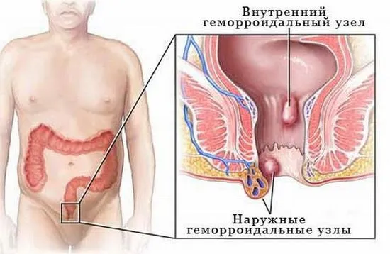 хемороиди