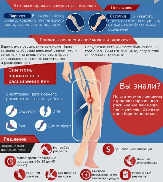 Лазерна коагулация на разширени вени