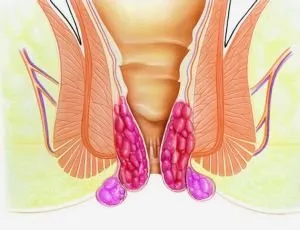 Какви са видовете и стадиите на хемороидите, класификация, лечение