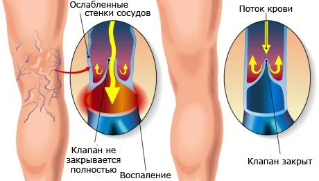 Флебектомията е операция за отстраняване на разширени вени