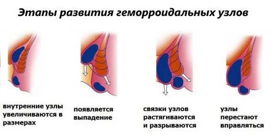 Самолечение на хемороиди. Какво трябва да се направи