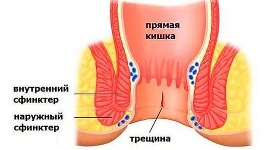 Лечение и симптоми на ректална фисура