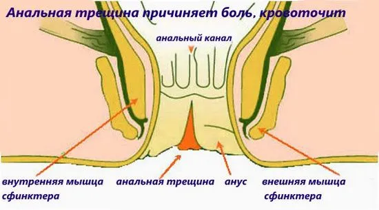 пукнатина в ануса снимка