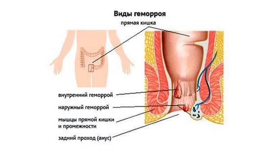 Какво предлага народната медицина за лечение на хемороиди у дома