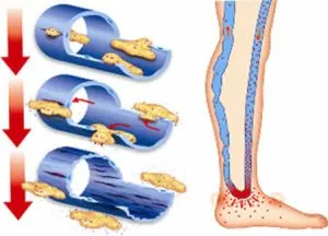 Флебопатия на долните крайници причини, симптоми и лечение