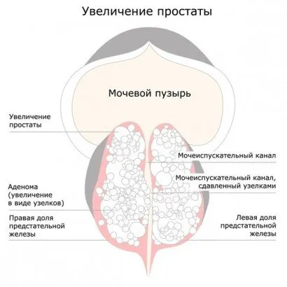 Профилактика на простатит