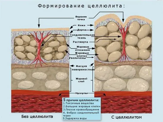 Как да се борим с целулита с разширени вени