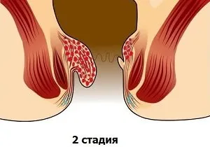 Симптоми и лечение на хемороиди от 2-ри етап (степен), остри и хронични