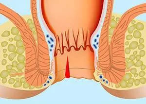 Лечение на пукнатини в ануса у дома