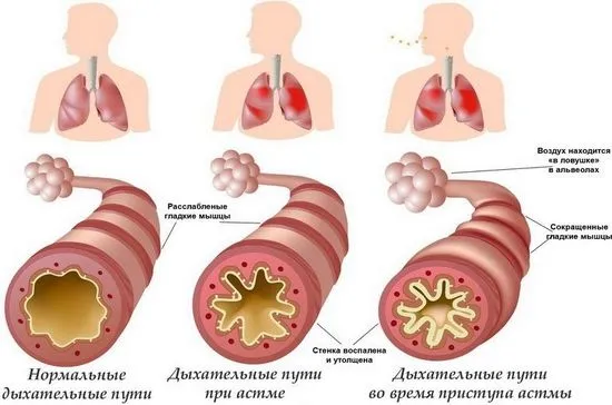 Астма - причини, симптоми, лечение с народни средства