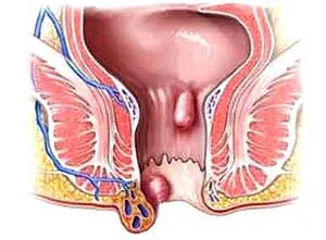 Начини да се отървете от хемороиди