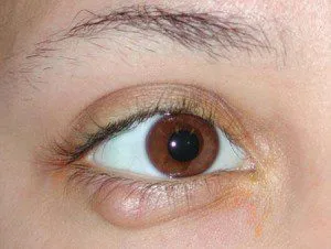 pleoapelor boala de ochi
