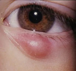 pleoapelor boala de ochi