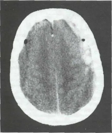 hematom subdural cronică