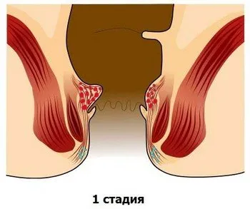 Етапи на хемороиди, техните симптоми и лечение