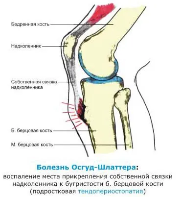 Болест на Osgood Schlatter