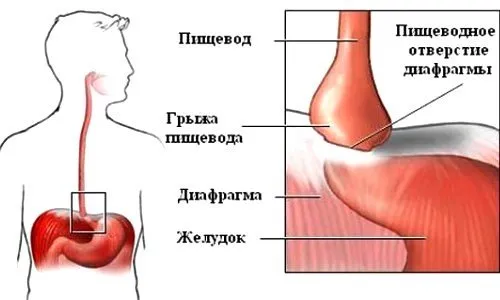 Лечение и хирургия на херния на хранопровода