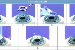 lasik