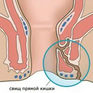 Оперативно лечение на ректална фистула