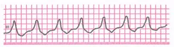 Пароксизмална тахикардия